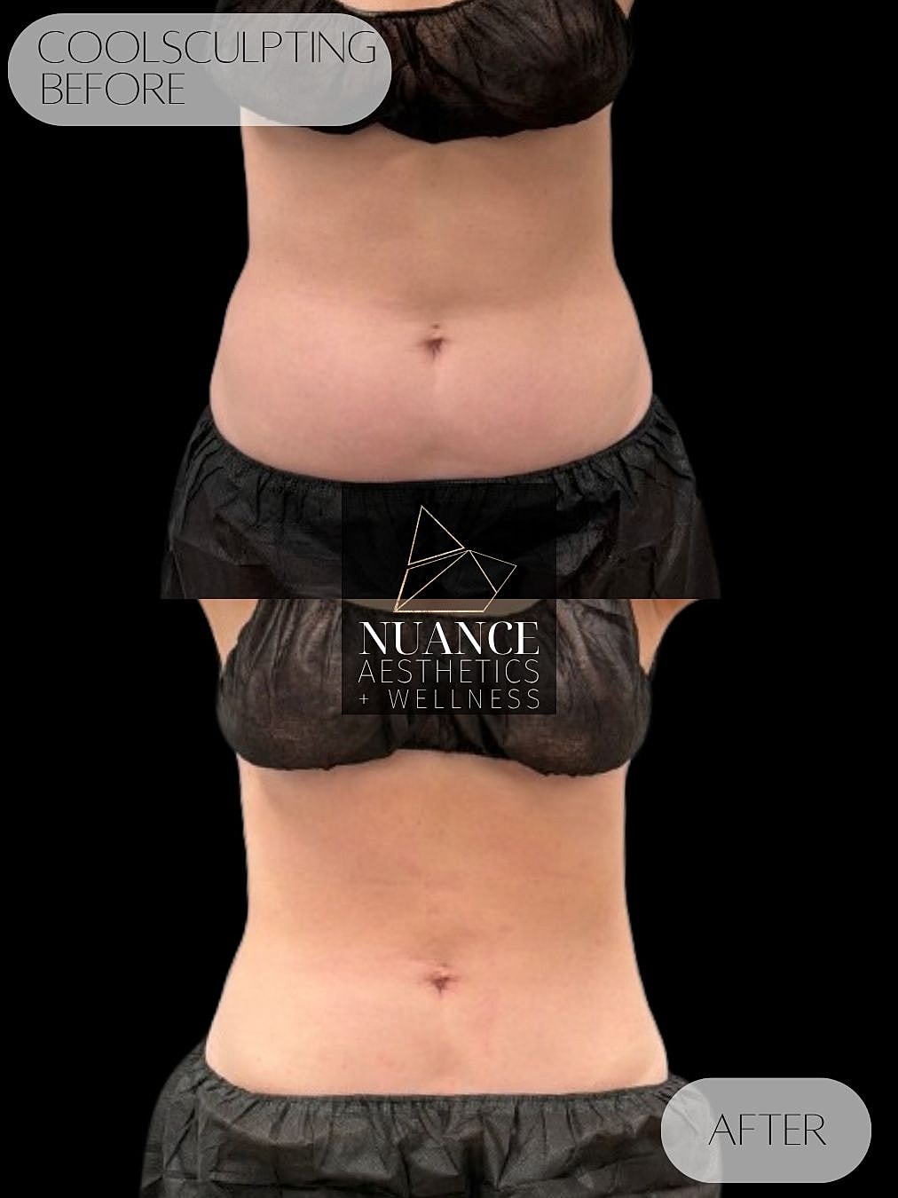 CoolSculpting® Before & After