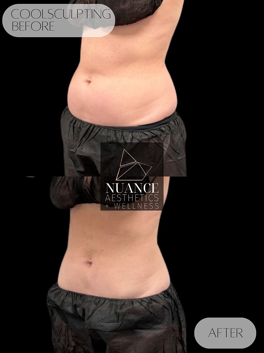 CoolSculpting® Before & After
