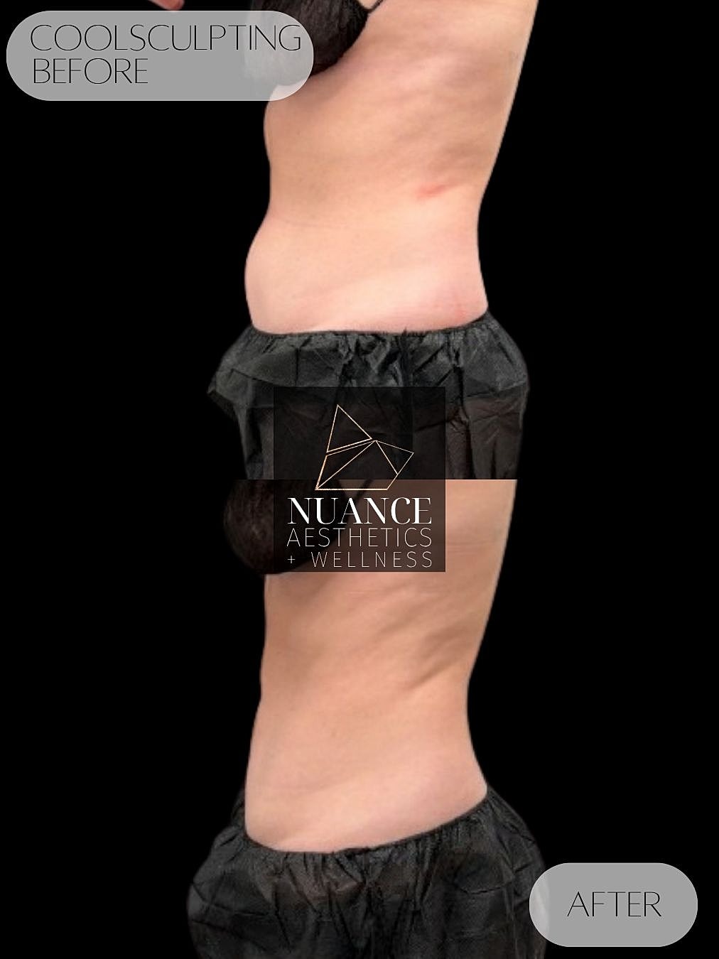 CoolSculpting® Before & After