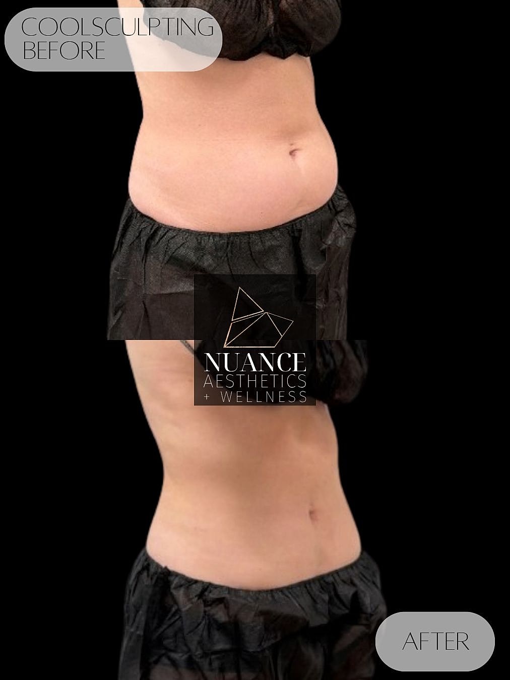 CoolSculpting® Before & After
