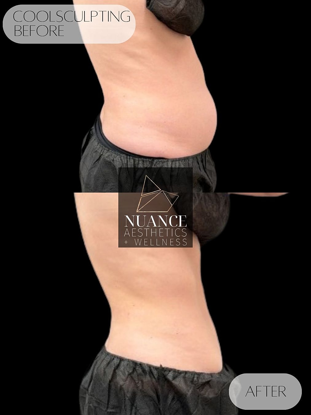 CoolSculpting® Before & After
