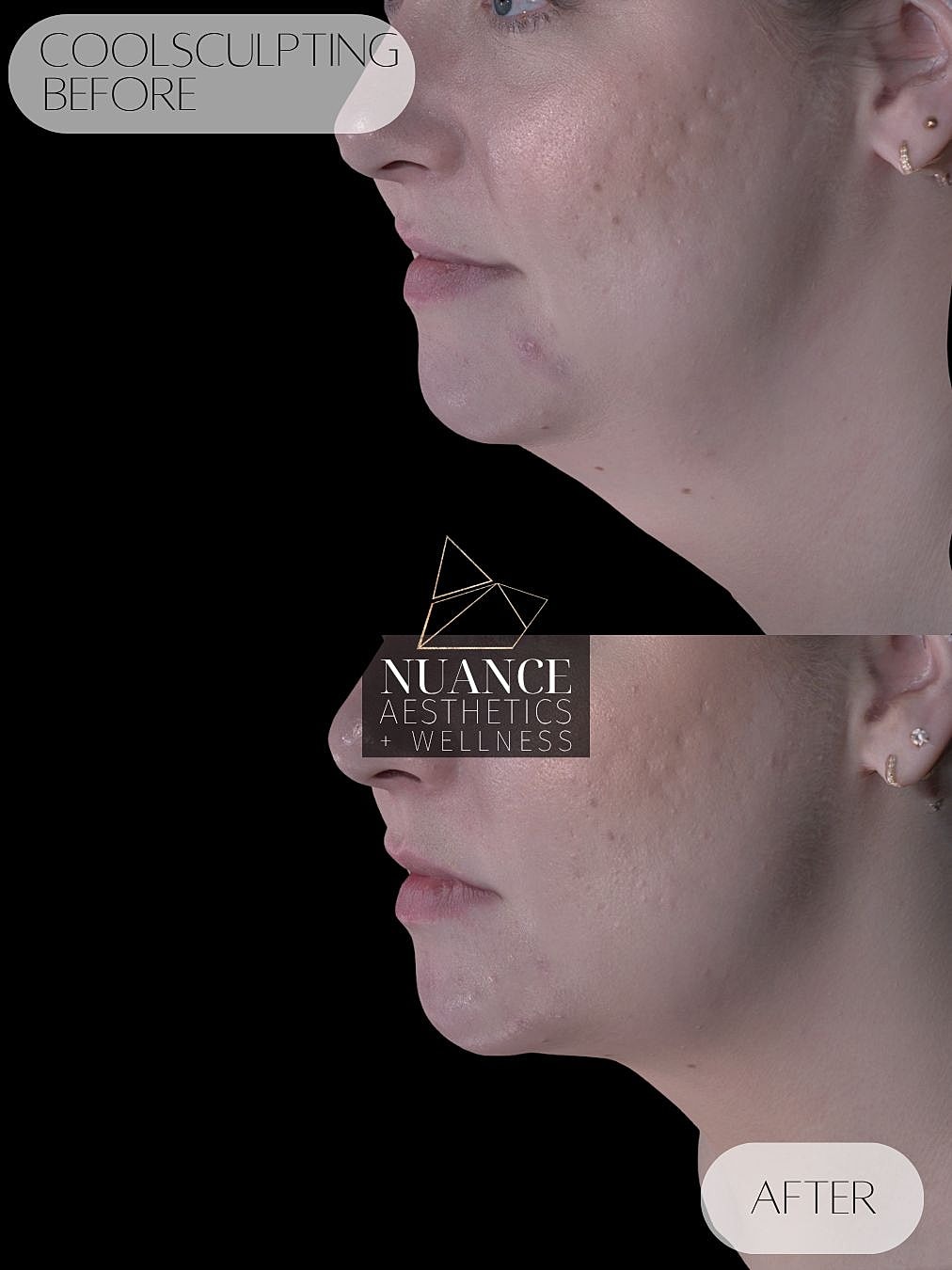 CoolSculpting® Before & After