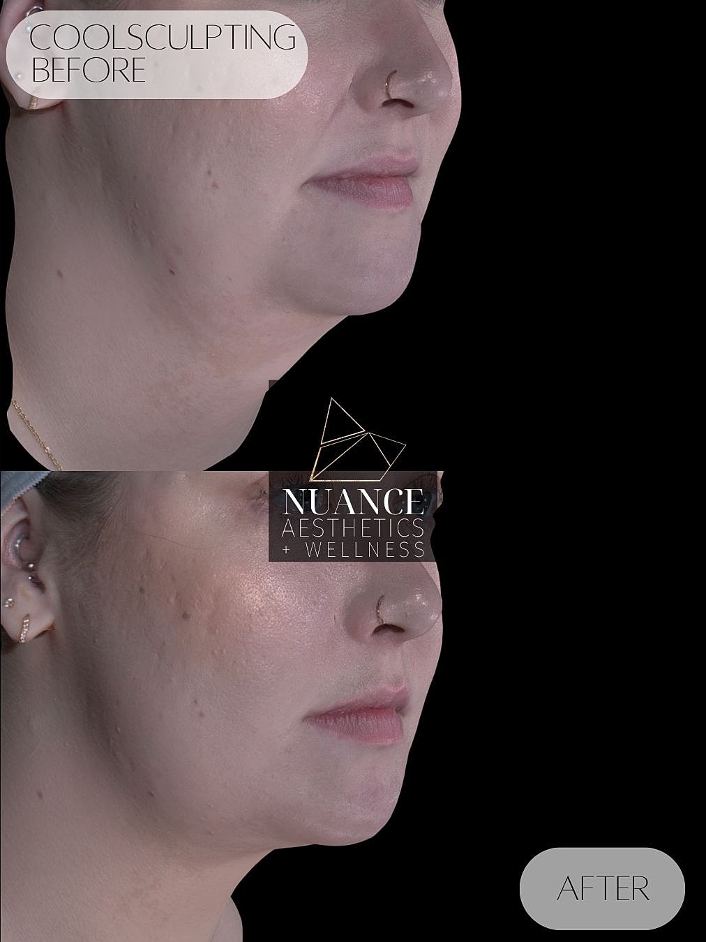 CoolSculpting® Before & After