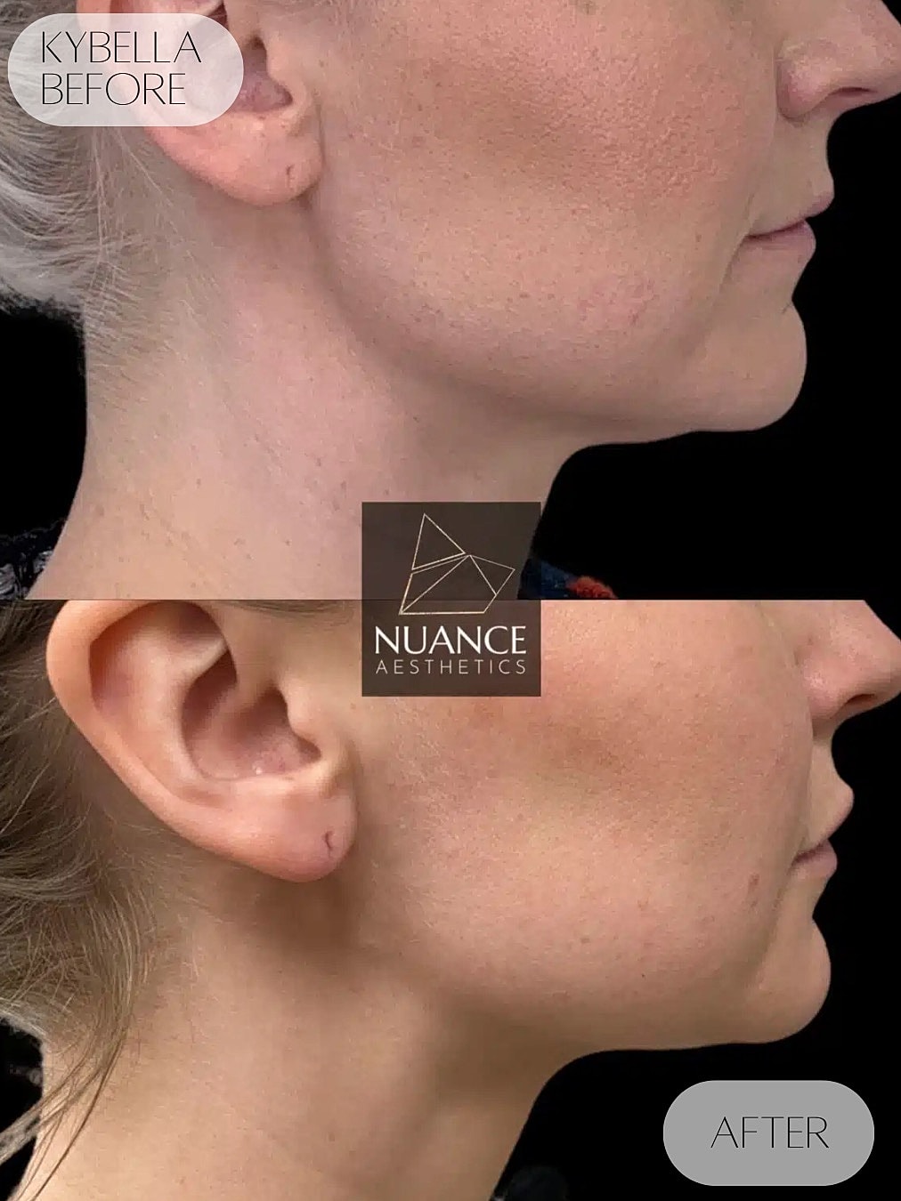 Kybella Before & After