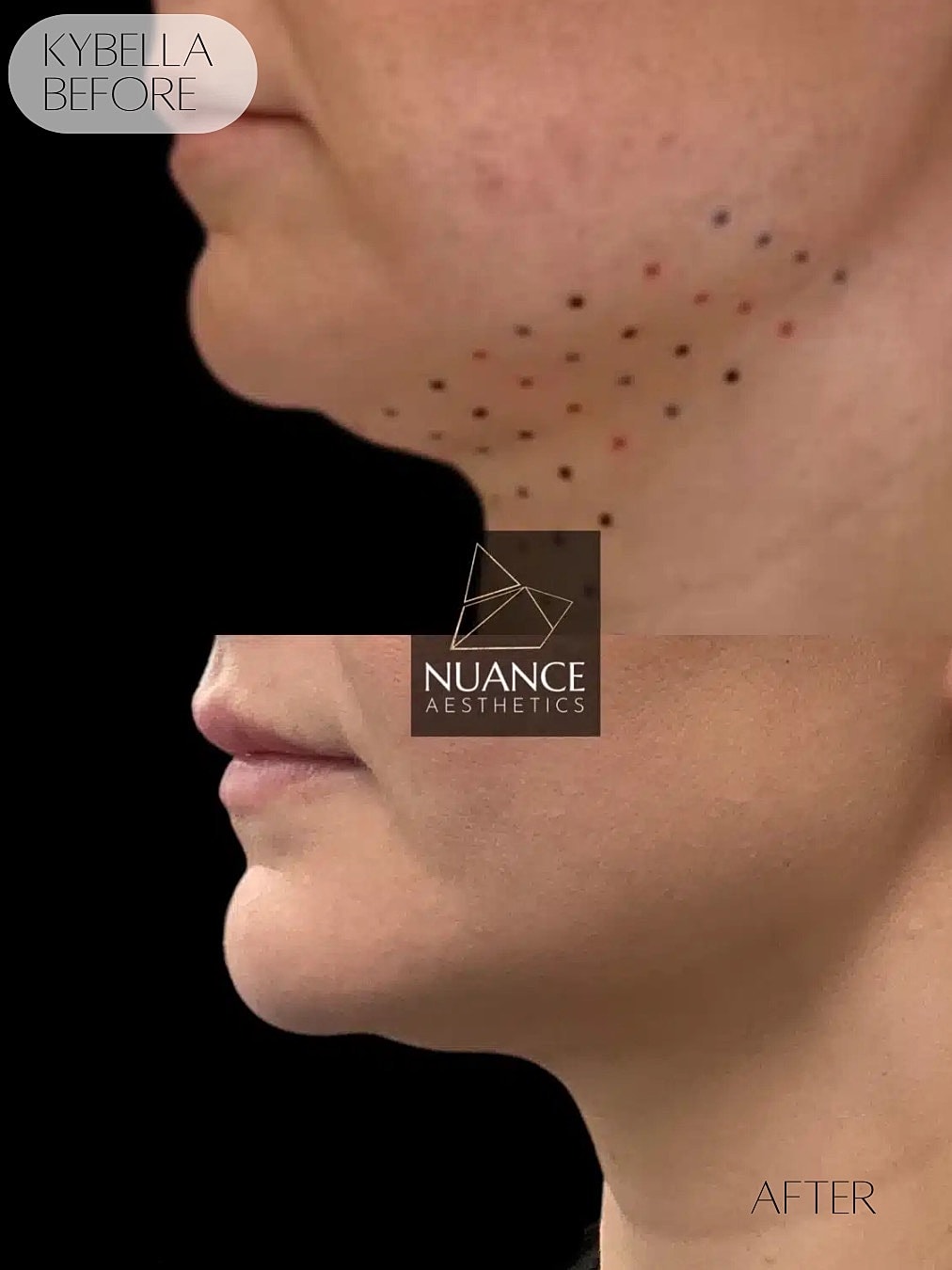 Kybella Before & After