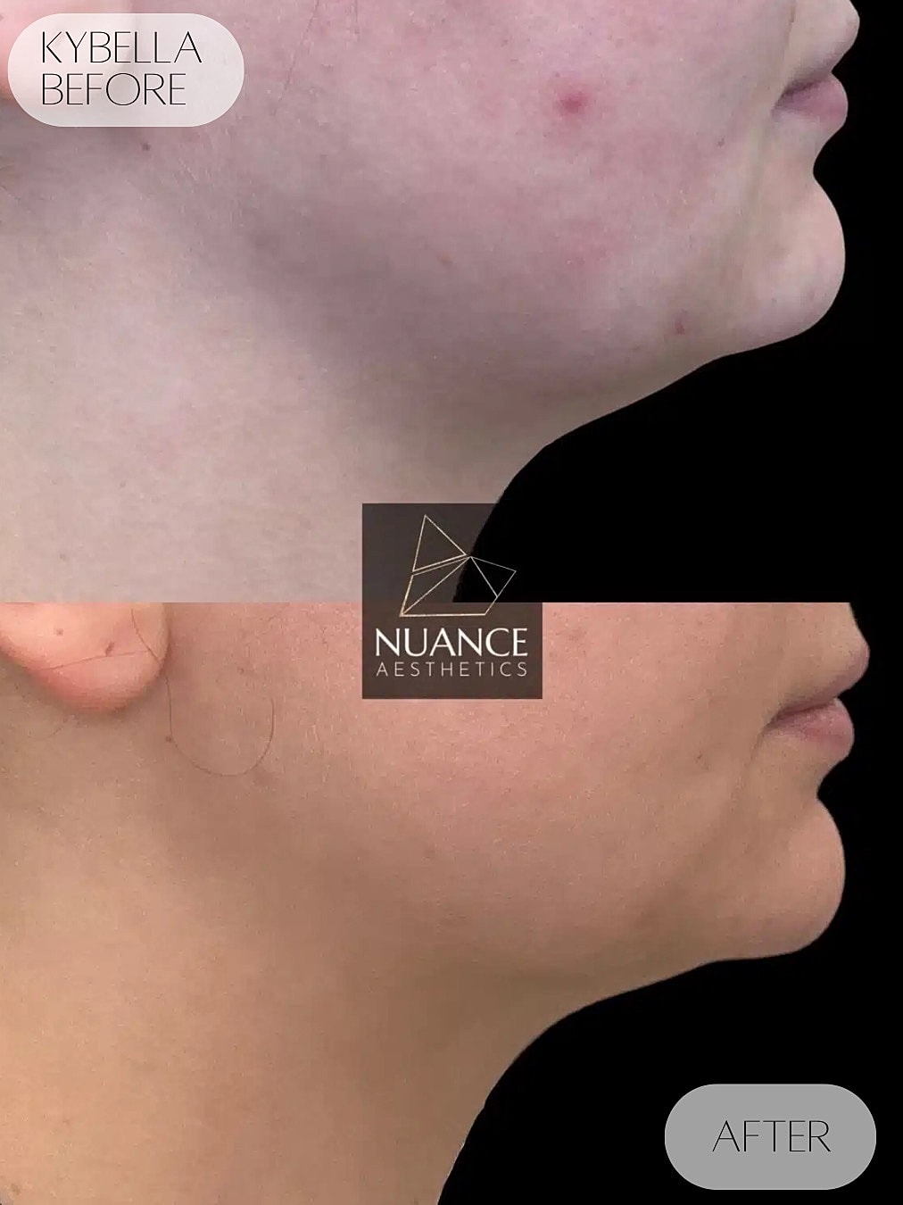 Kybella Before & After