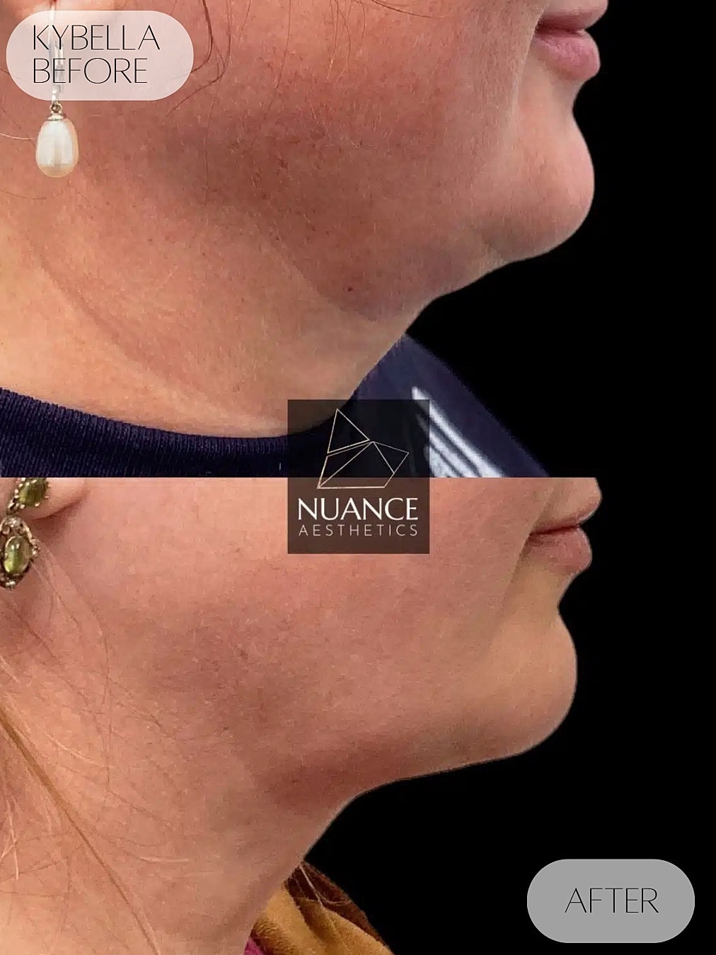 Kybella Before & After