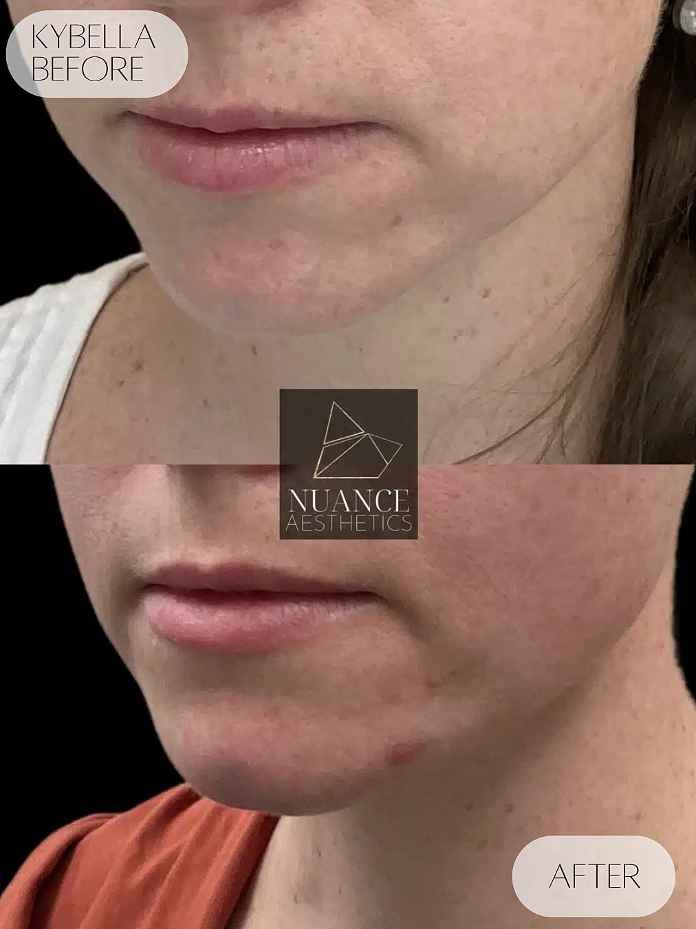 Kybella Before & After