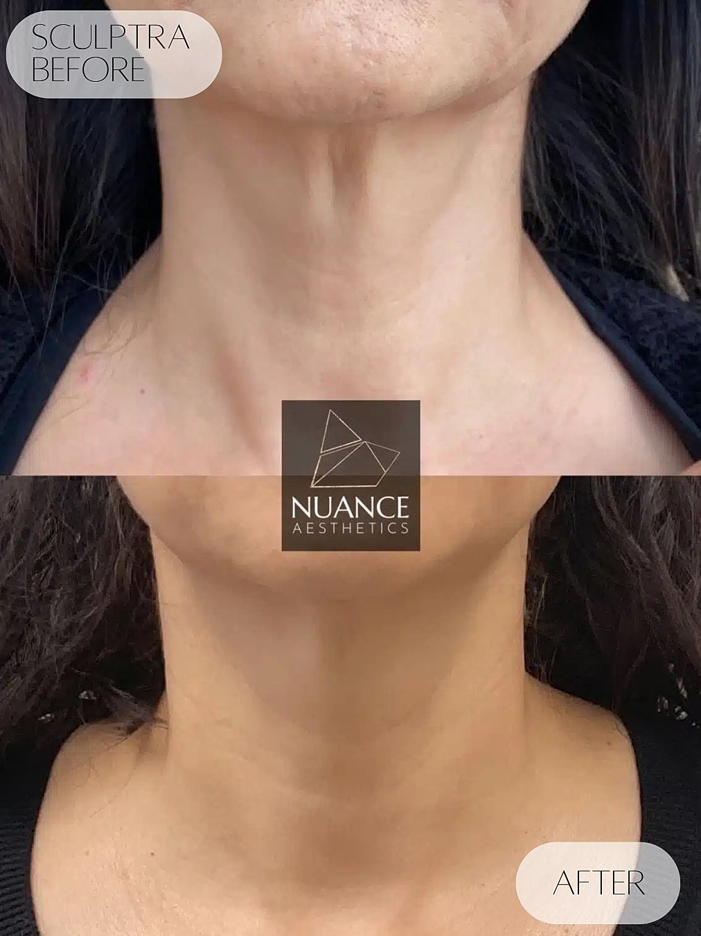 Sculptra Before & After