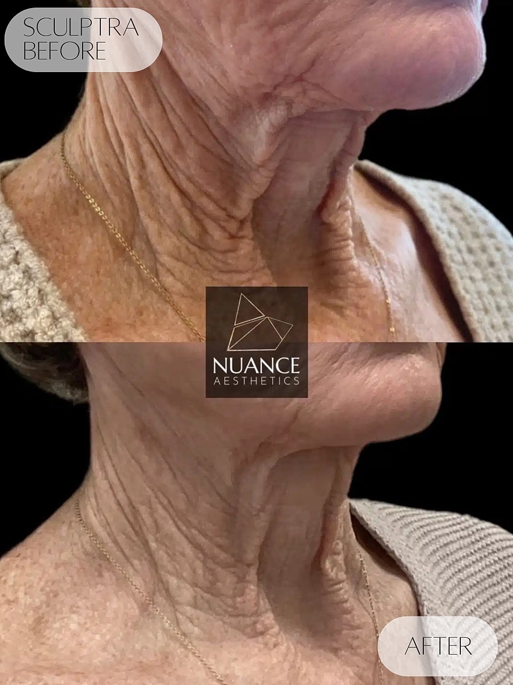 Sculptra Before & After