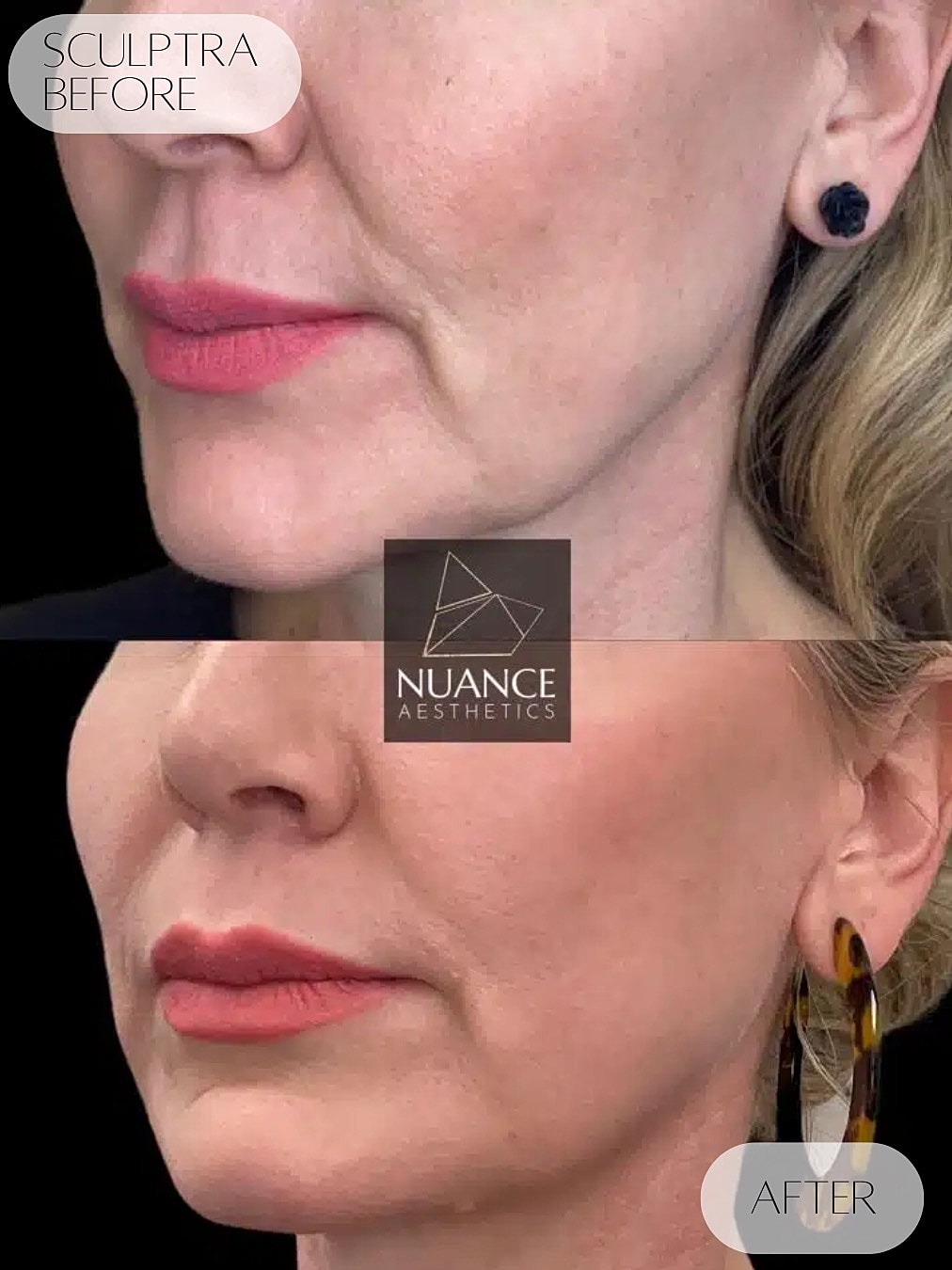 Sculptra Before & After