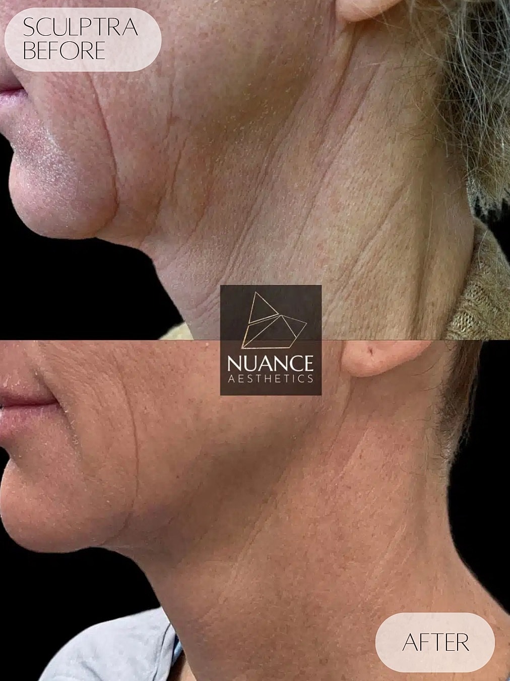Sculptra Before & After