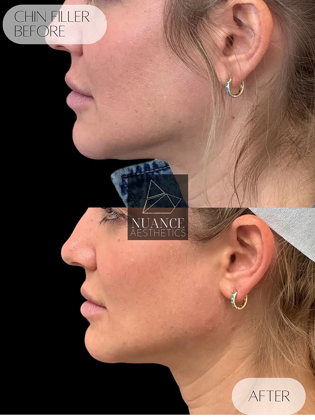Chin Filler Before & After