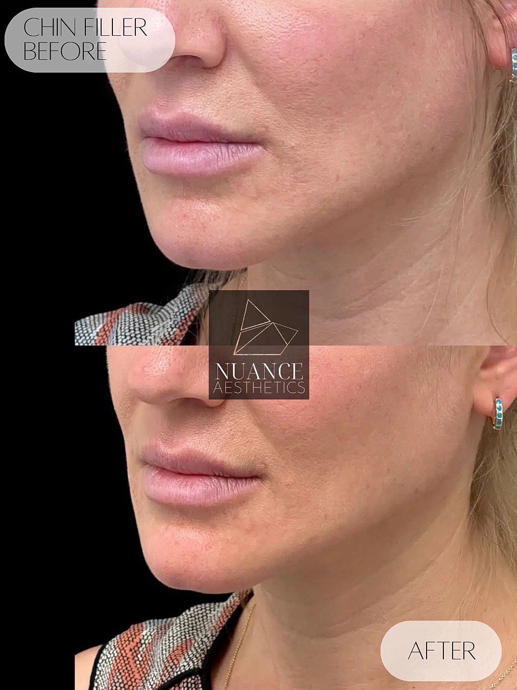 Chin Filler Before & After