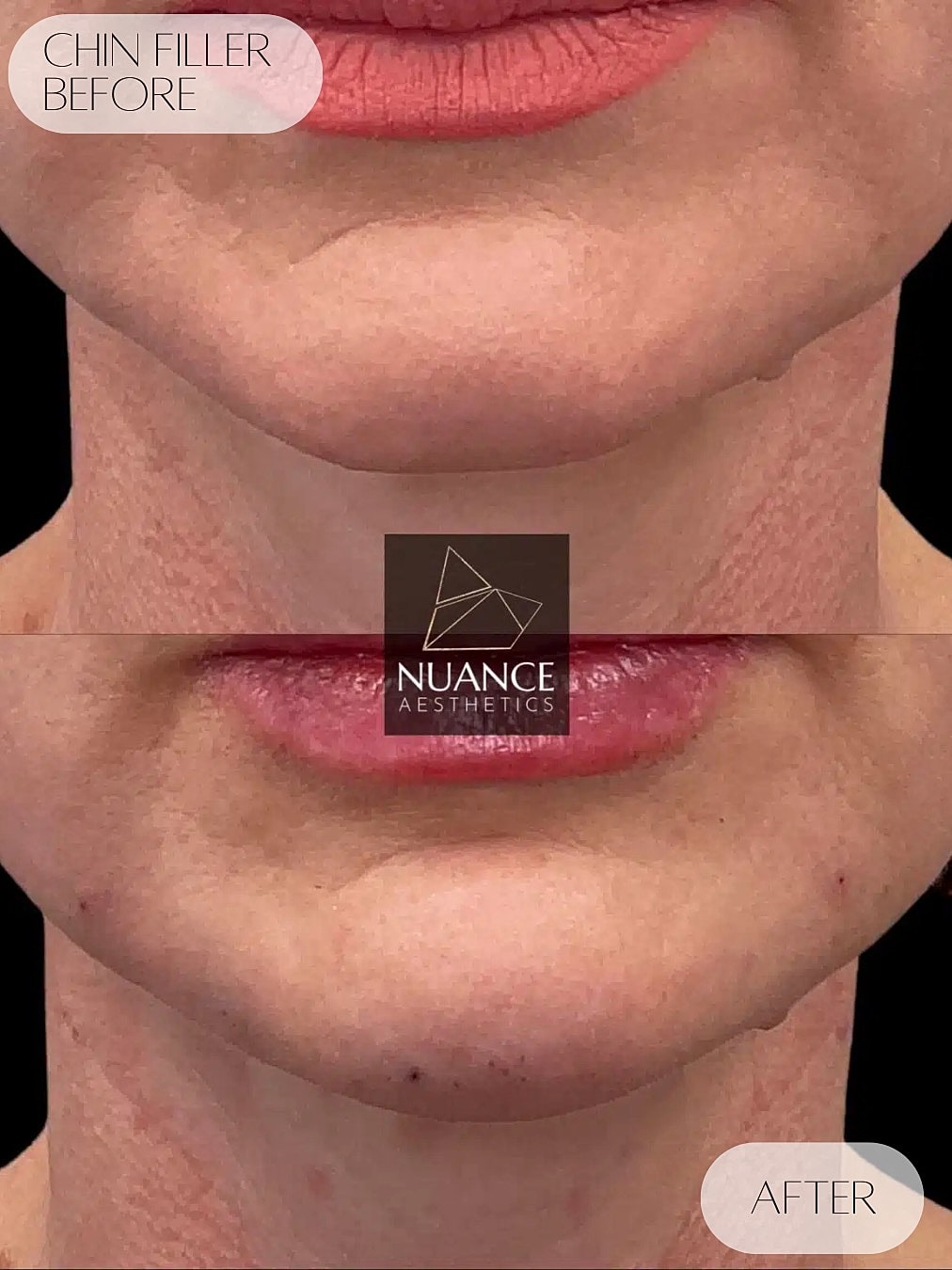 Chin Filler Before & After