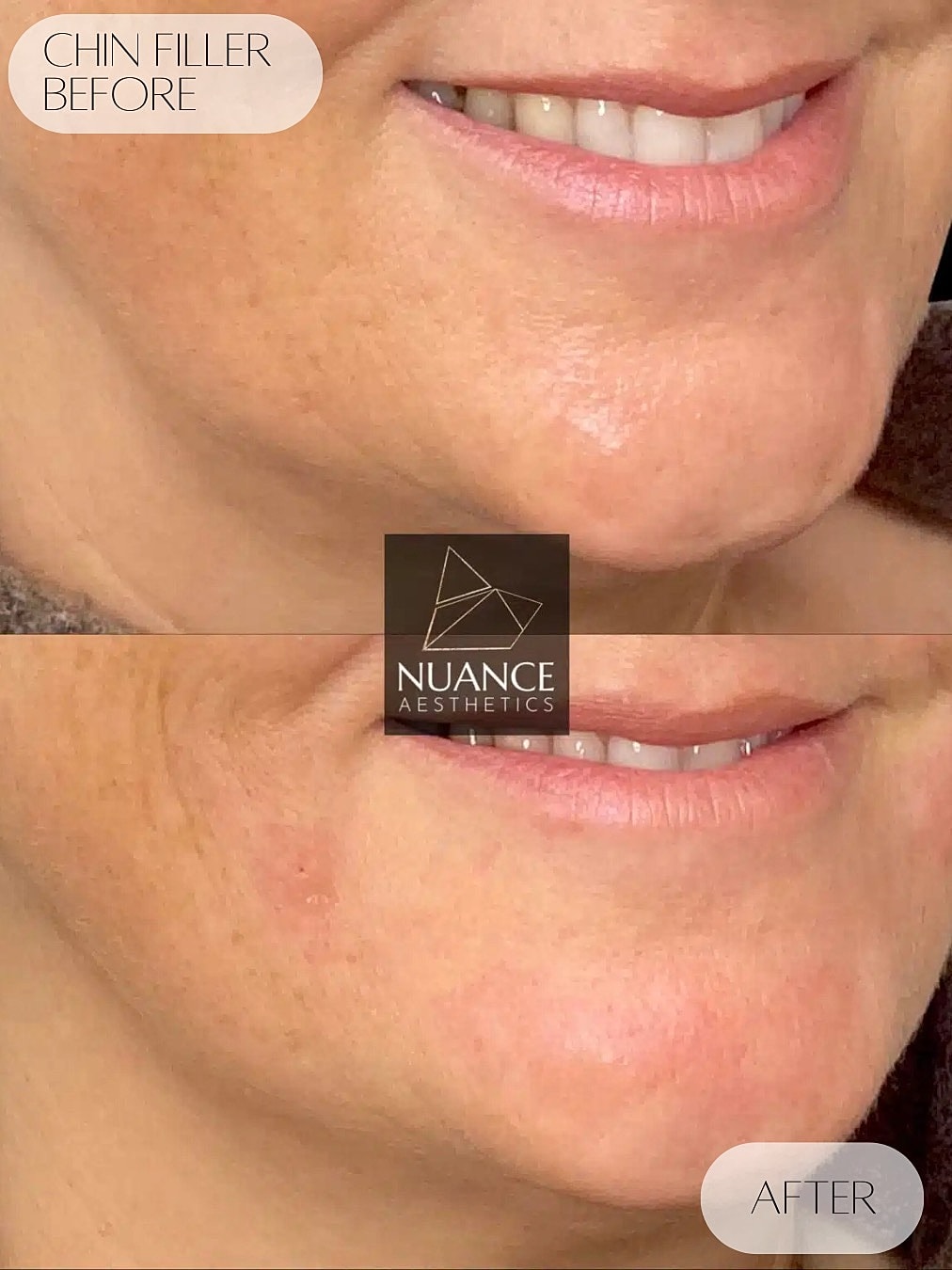 Chin Filler Before & After