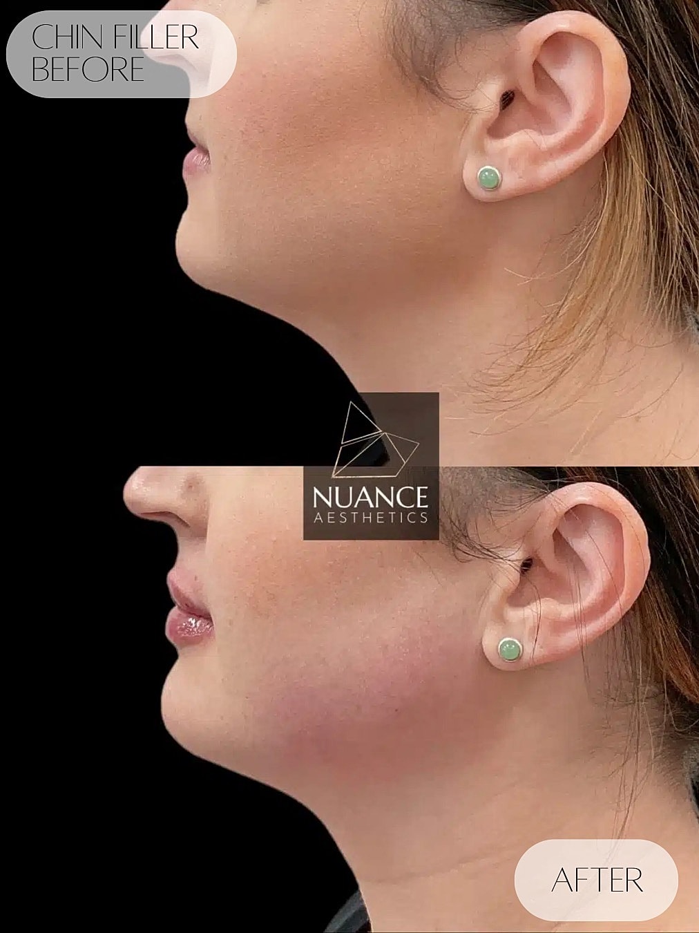 Chin Filler Before & After