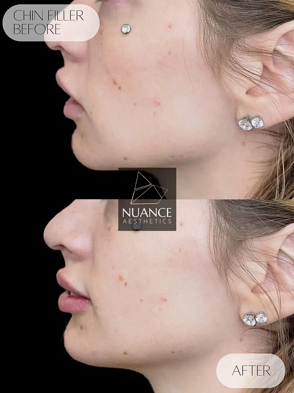 Chin Filler Before & After