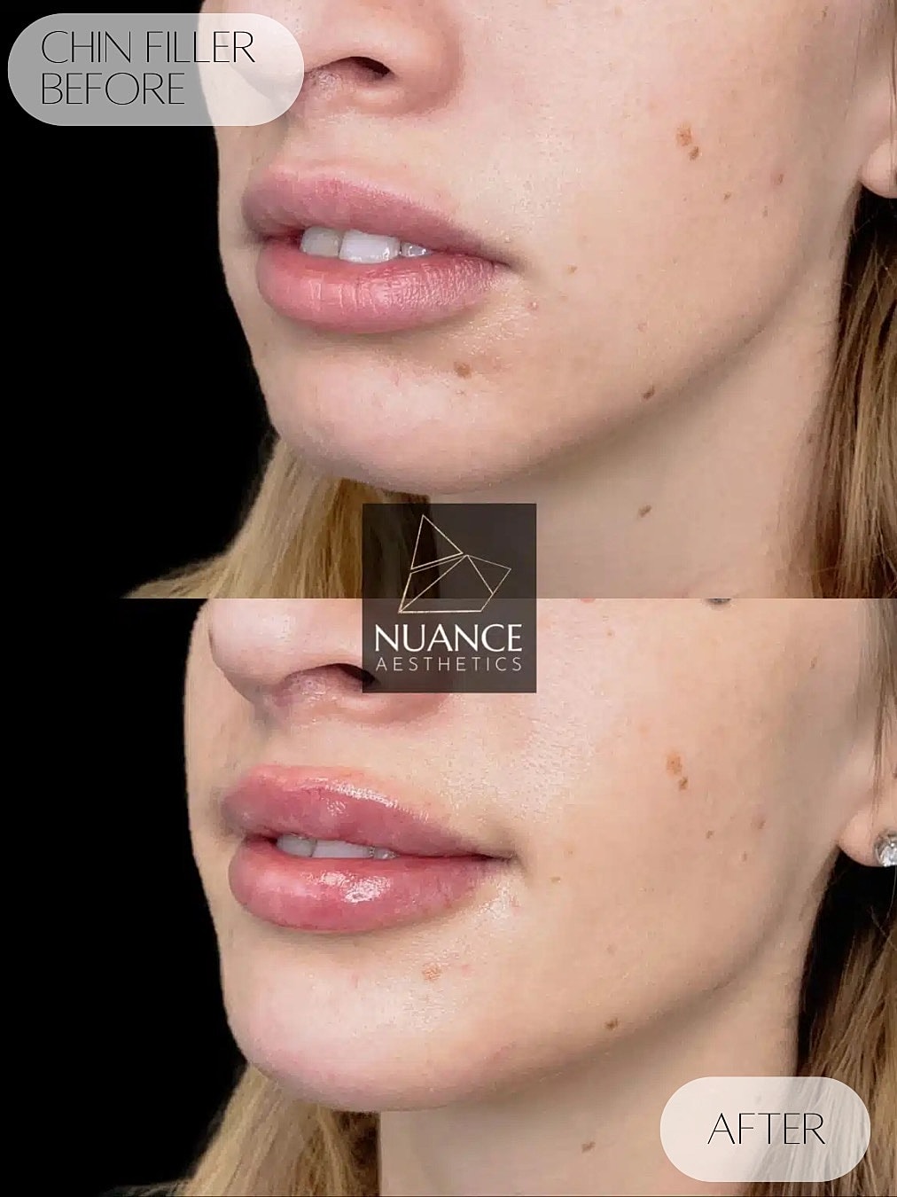 Chin Filler Before & After