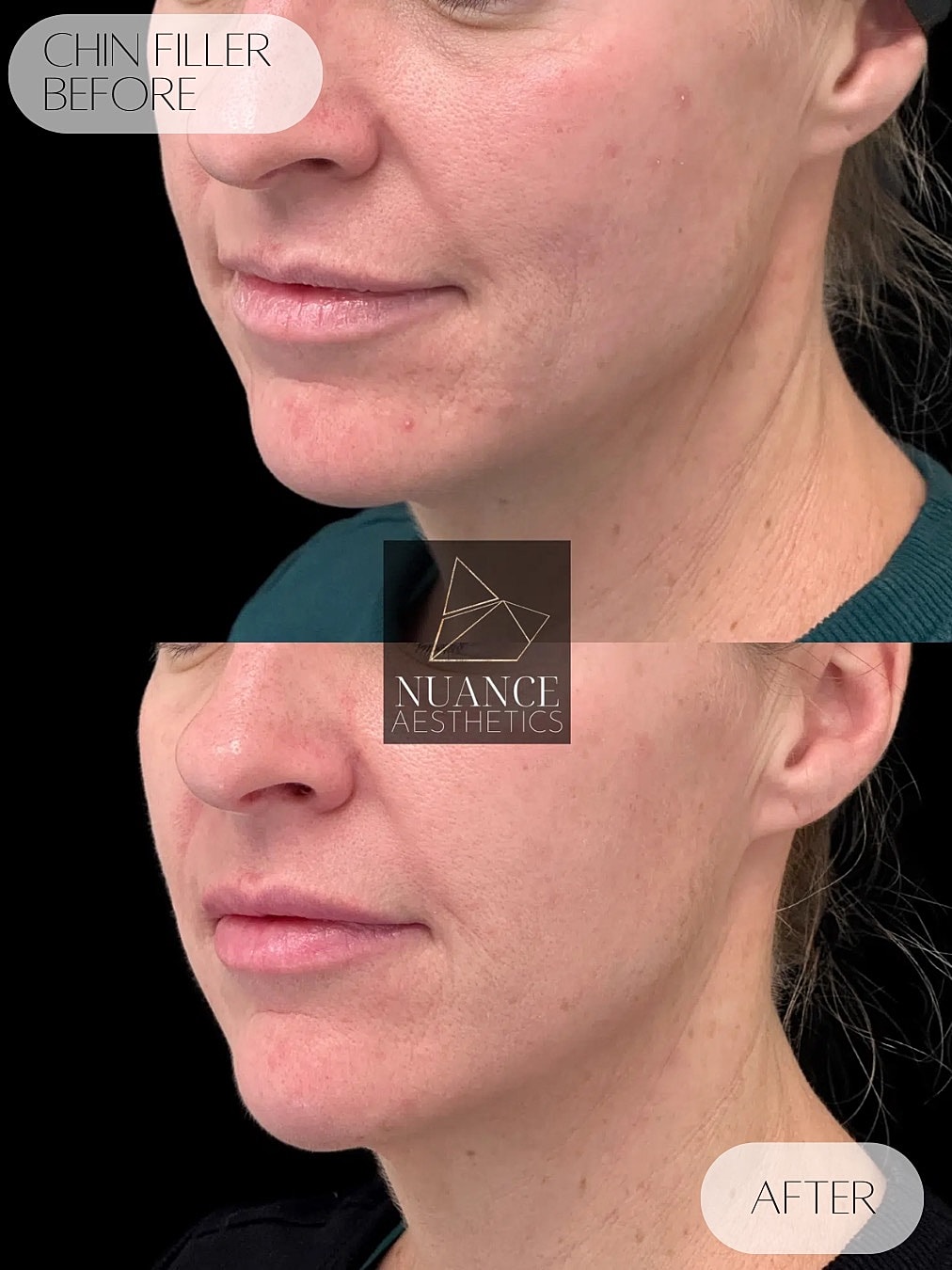 Chin Filler Before & After