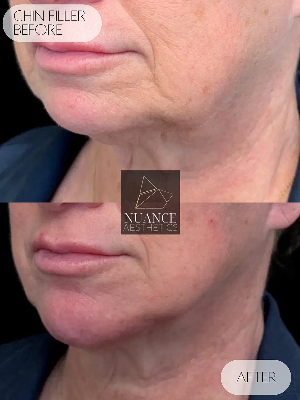 Chin Filler Before & After