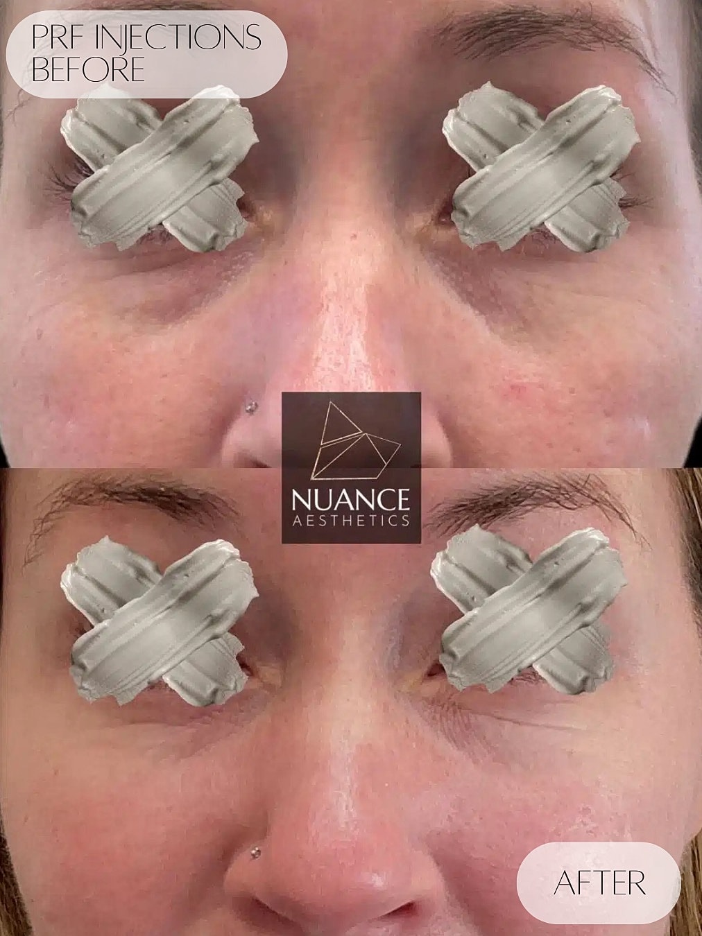 Prf Injections Before & After