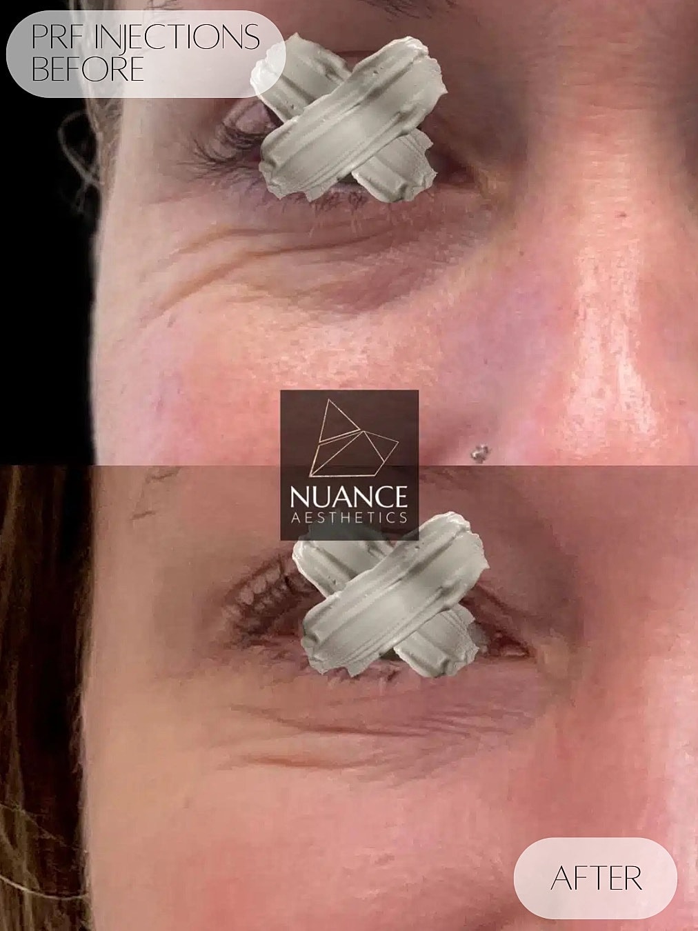 Prf Injections Before & After