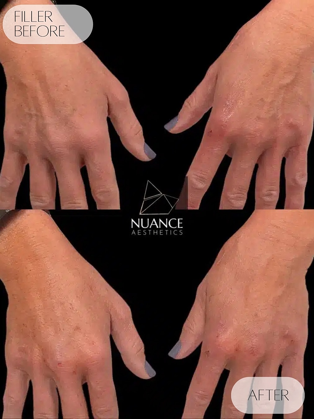 Dermal Fillers Before & After