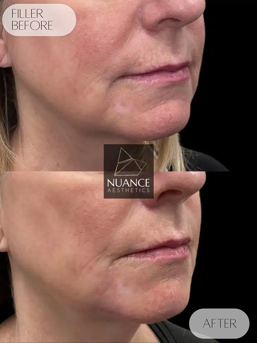Dermal Fillers Before & After