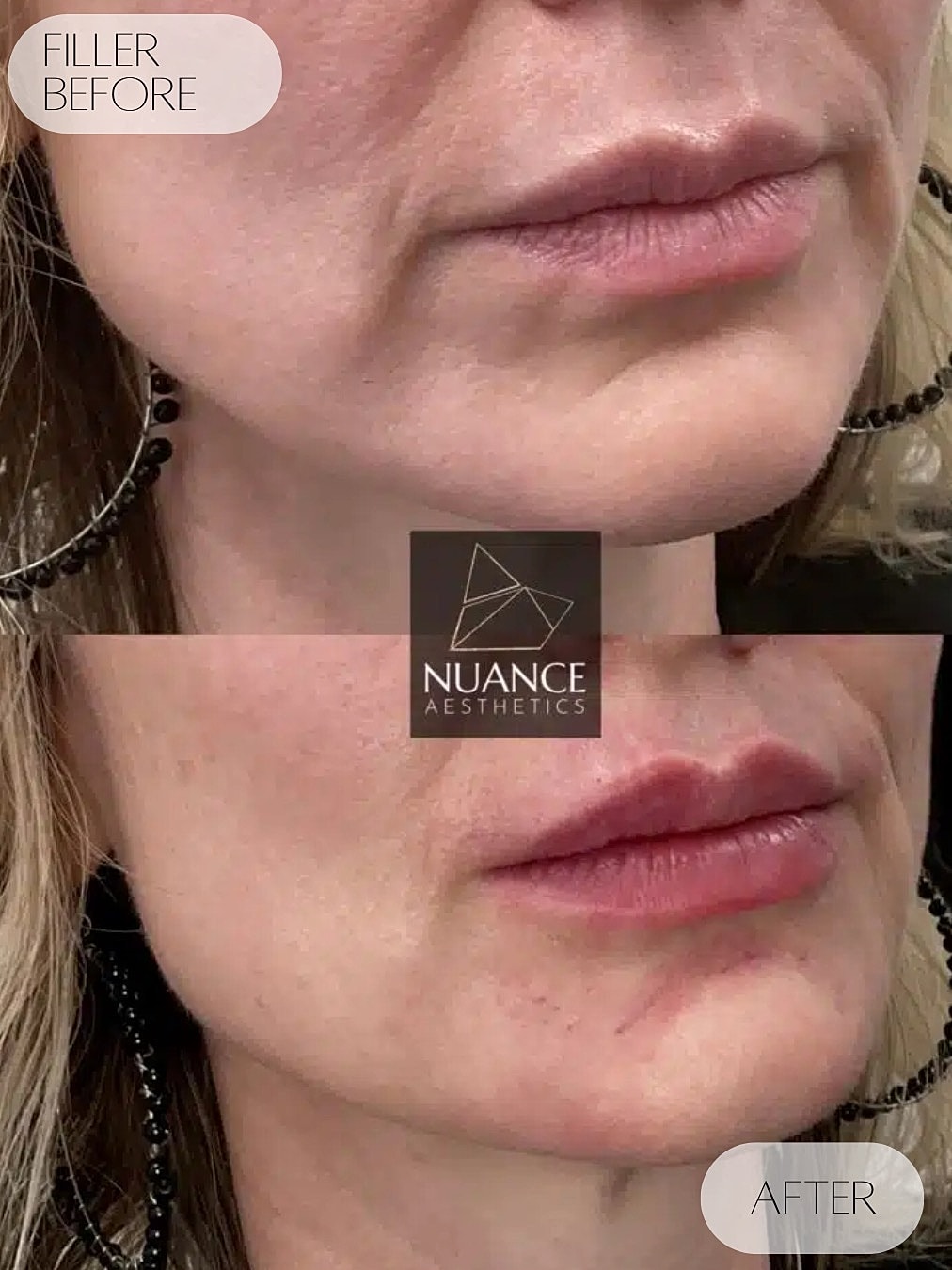 Dermal Fillers Before & After