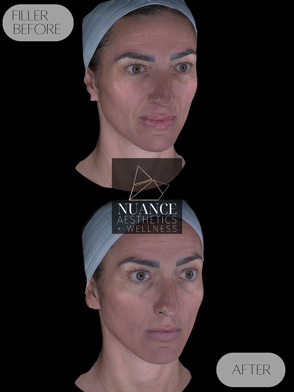 Dermal Fillers Before & After
