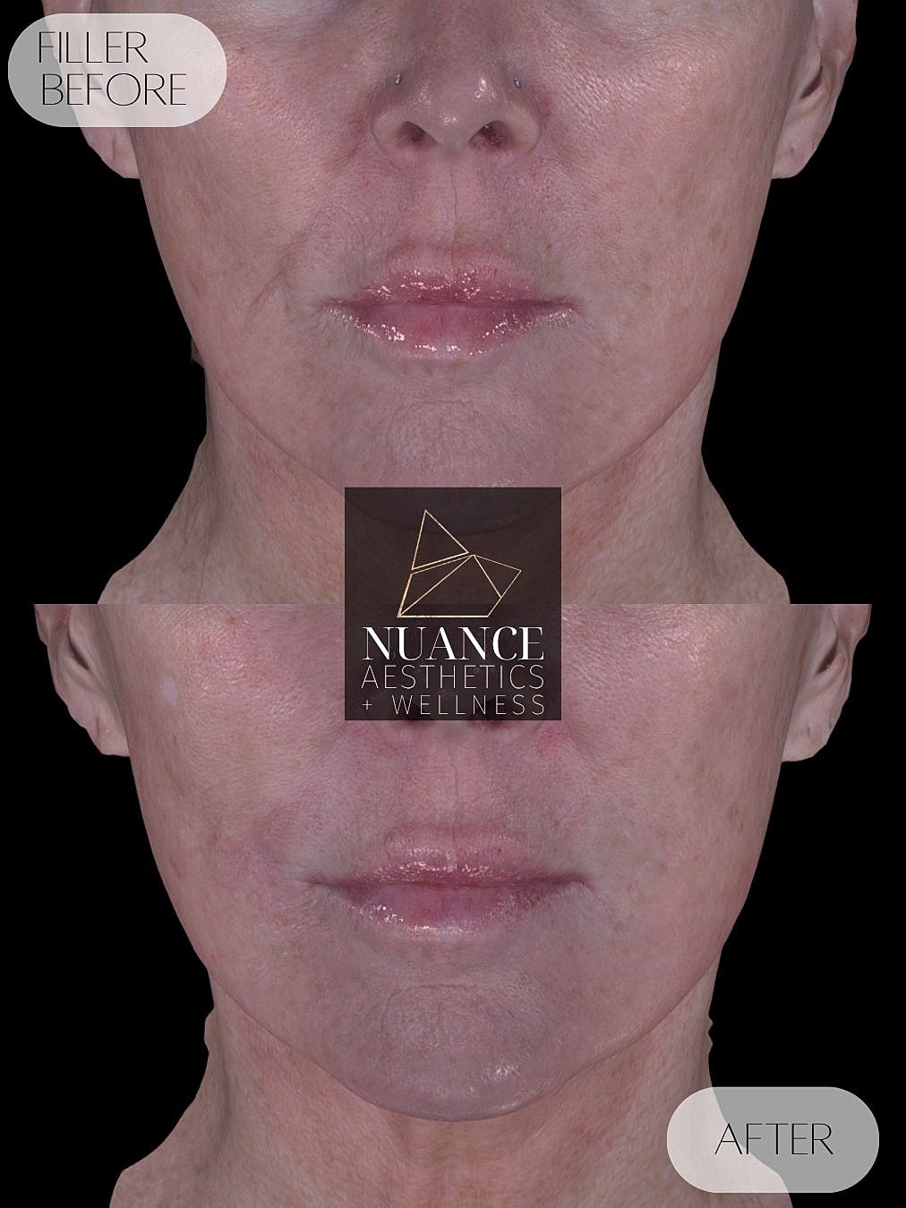Dermal Fillers Before & After