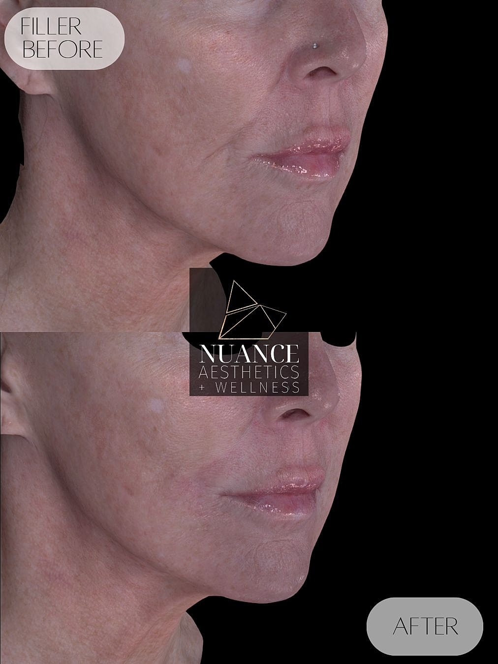 Dermal Fillers Before & After