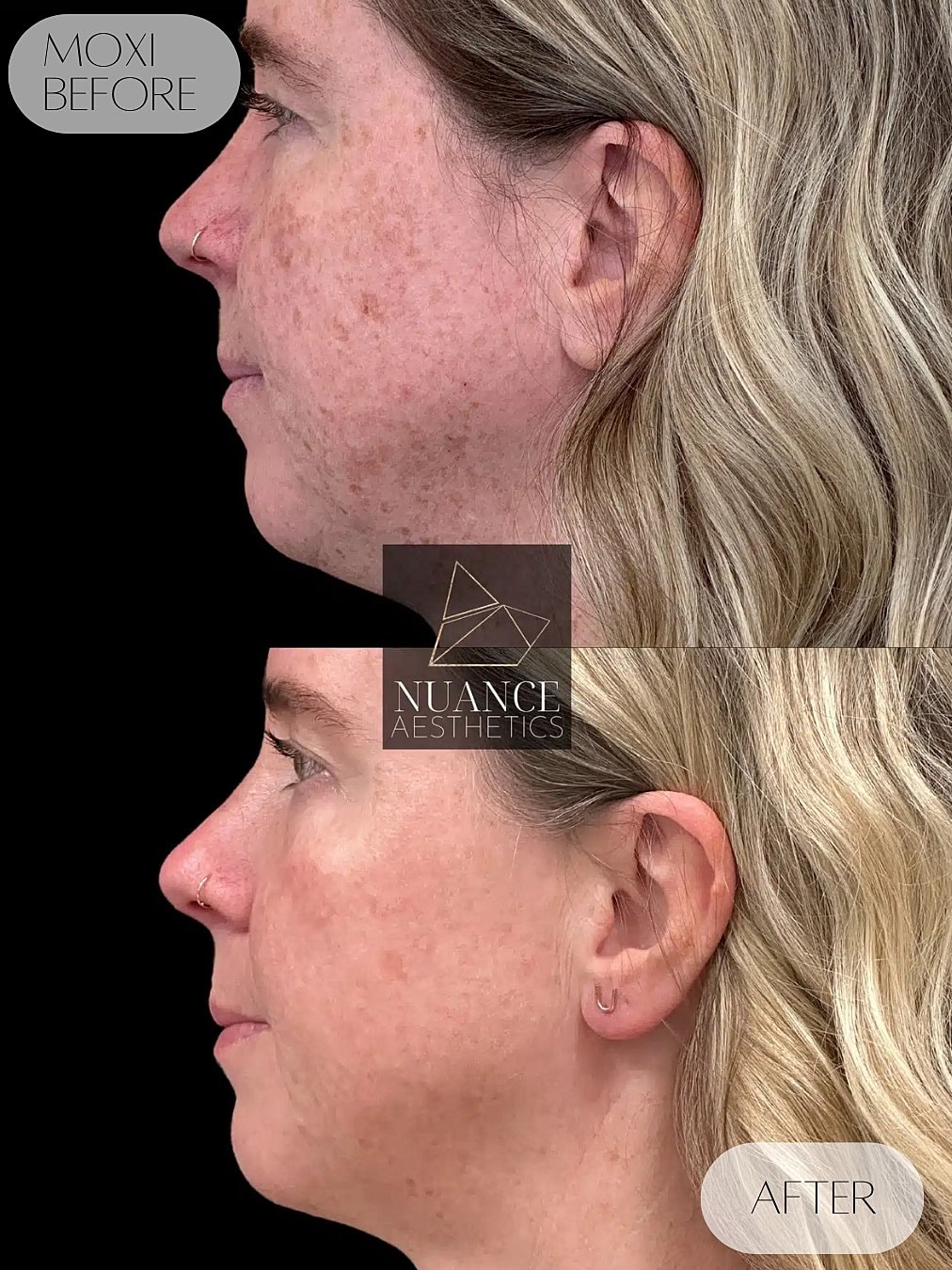 Moxi Laser Before & After