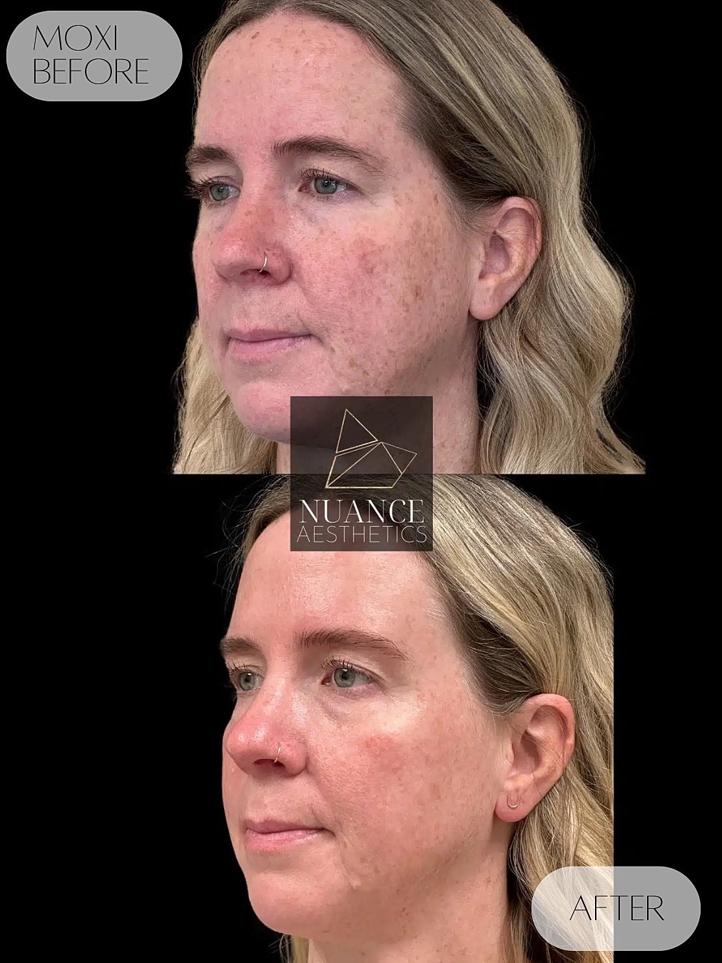 Moxi Laser Before & After