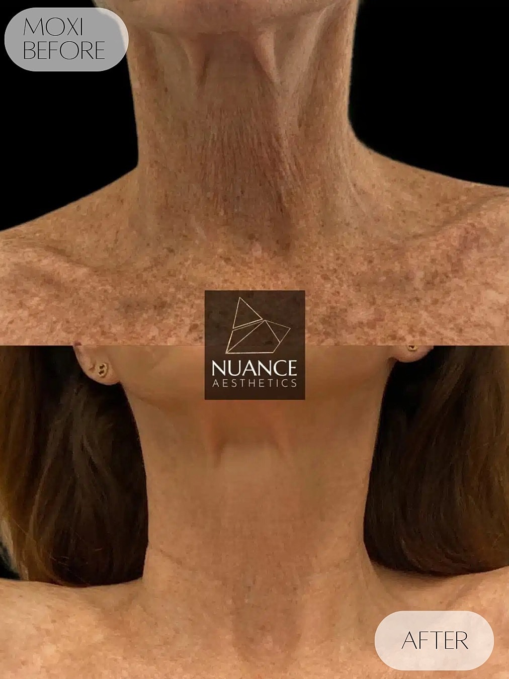 Moxi Laser Before & After