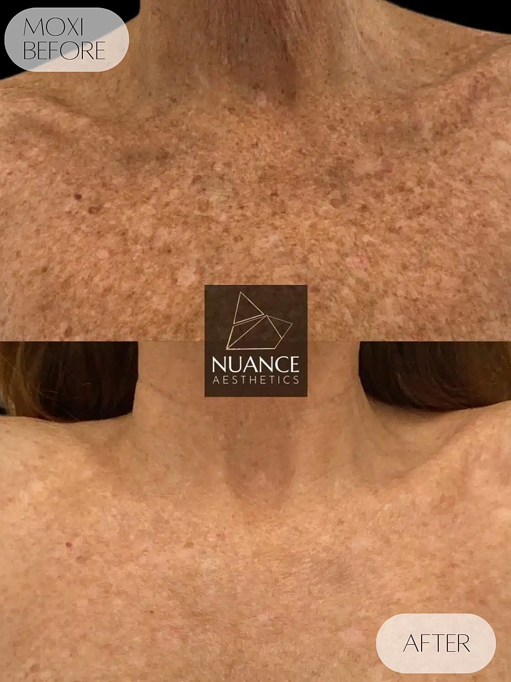 Moxi Laser Before & After