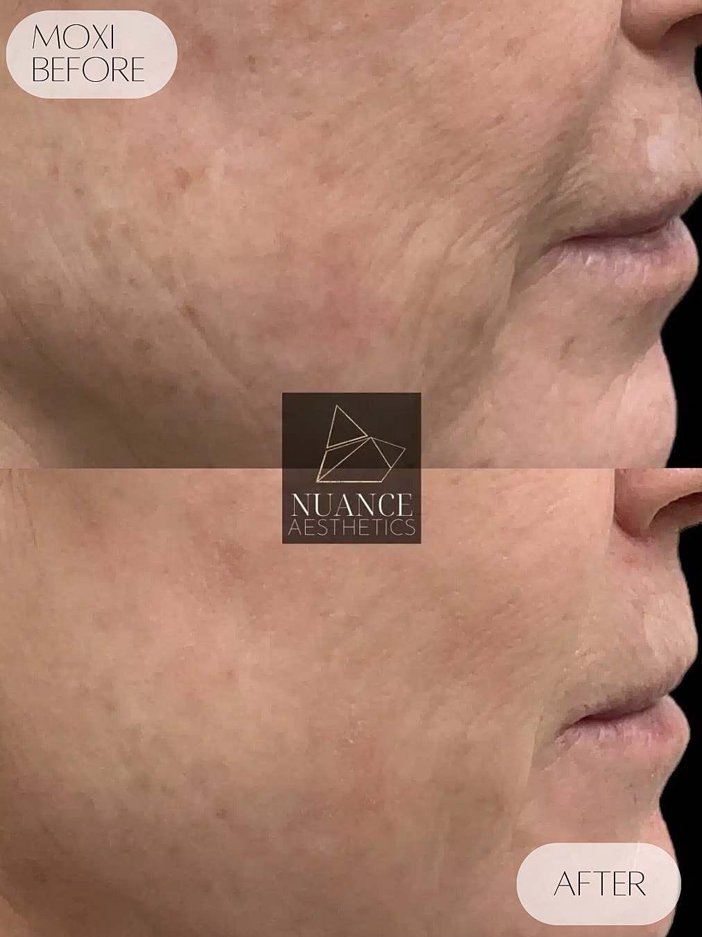 Moxi Laser Before & After
