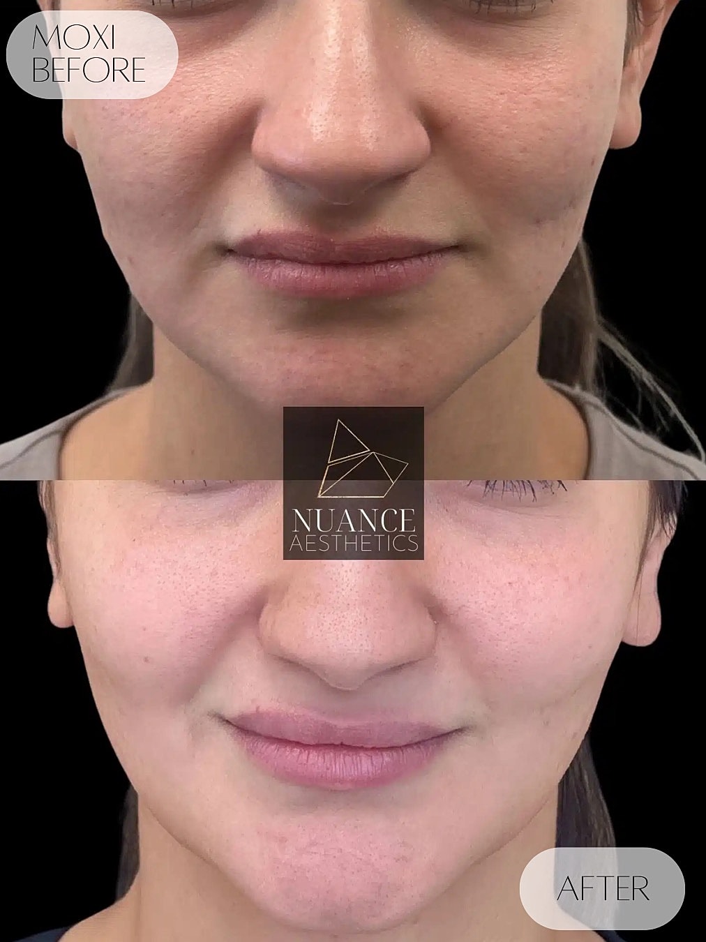 Moxi Laser Before & After